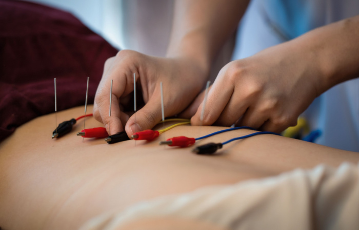Electroacupuncture